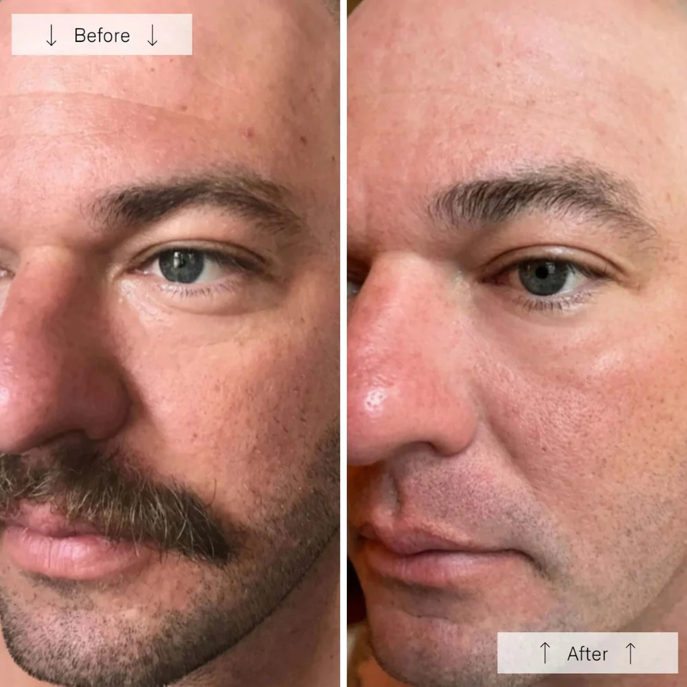 Omnilux Men LED Mask - Image 11