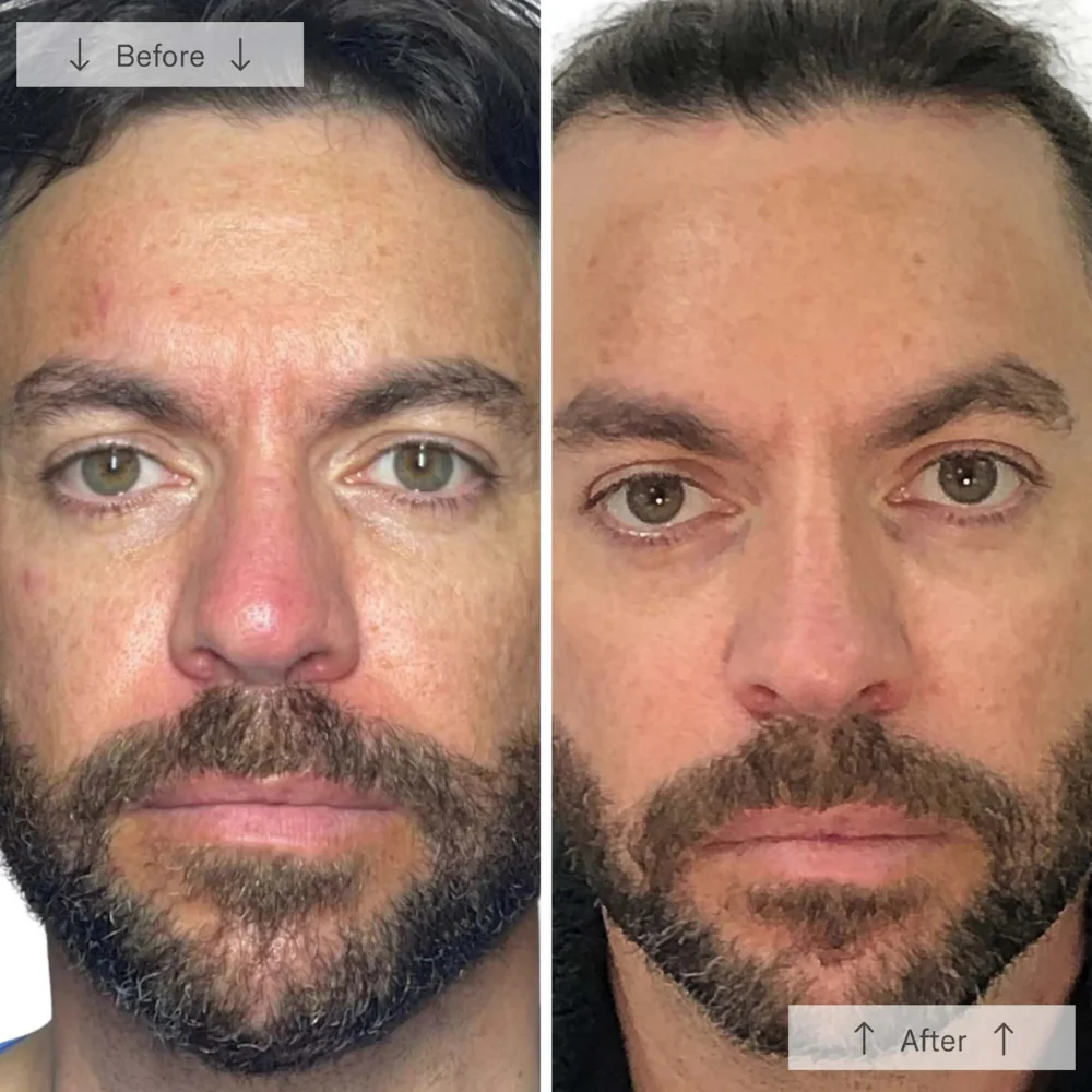 Omnilux Men LED Mask - Image 12